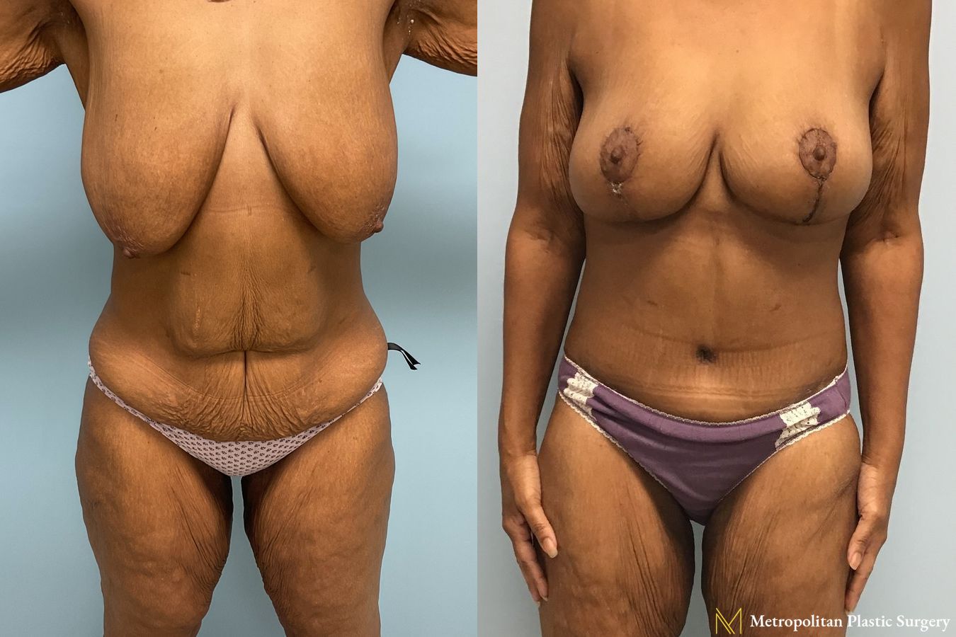 Before and after Tummy Tuck case 7999