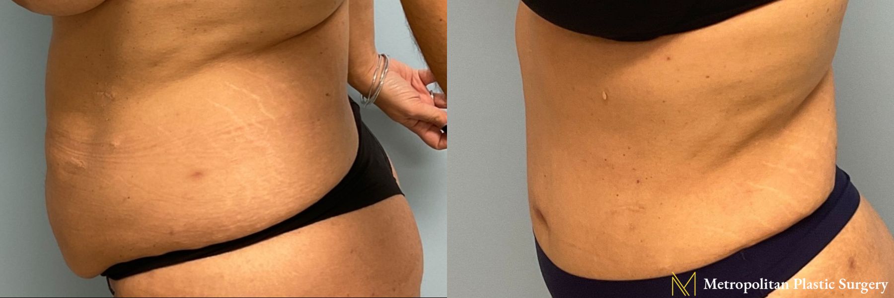 Before & after abdominoplasty photos for abdominoplasty - Angle 4