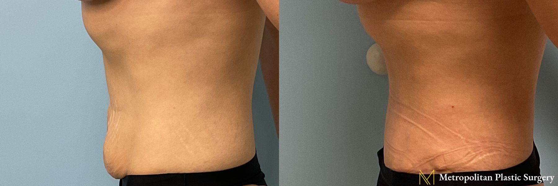 Tummy Tuck performed by Dr. Julia Spears - Angle 2
