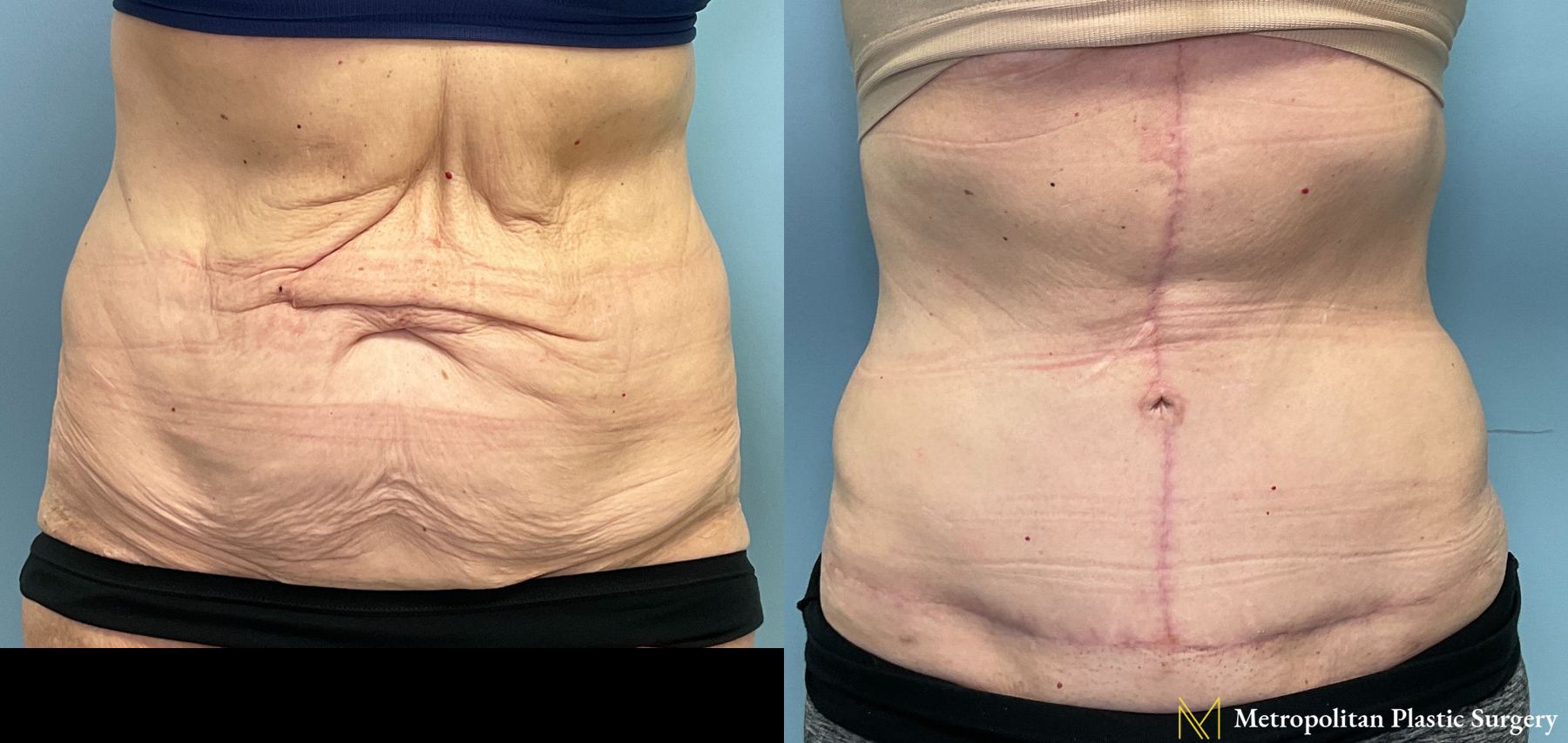 Vertical Tummy Tuck performed by Dr. Julia Spears at Metropolitan Plastic Surgery - Angle 2