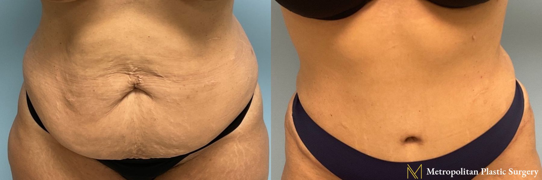 Before & after abdominoplasty photos for abdominoplasty