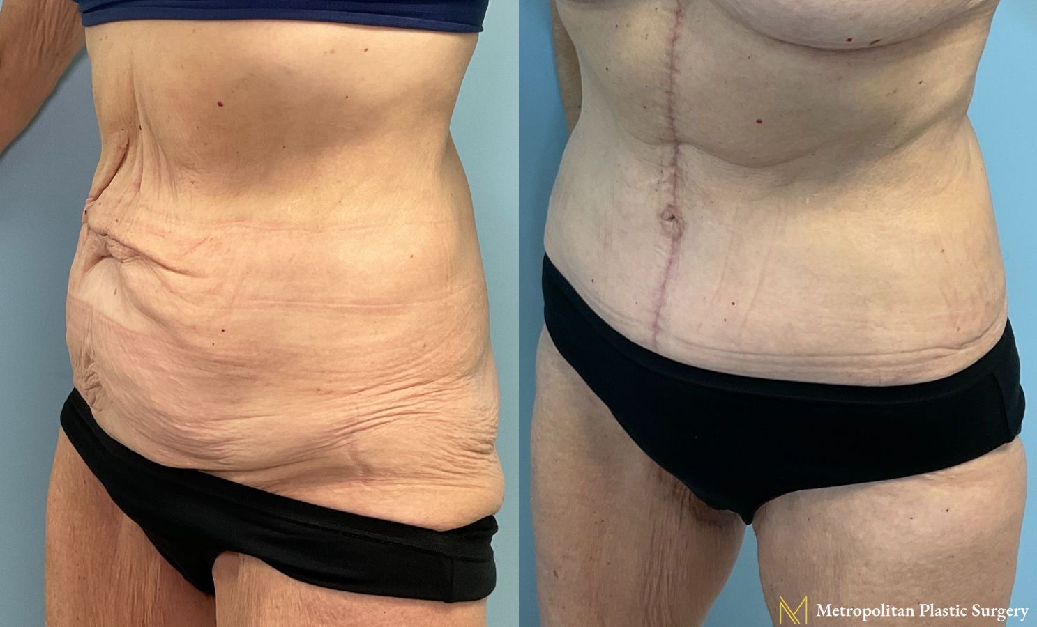 Vertical Tummy Tuck performed by Dr. Julia Spears at Metropolitan Plastic Surgery - Angle 3