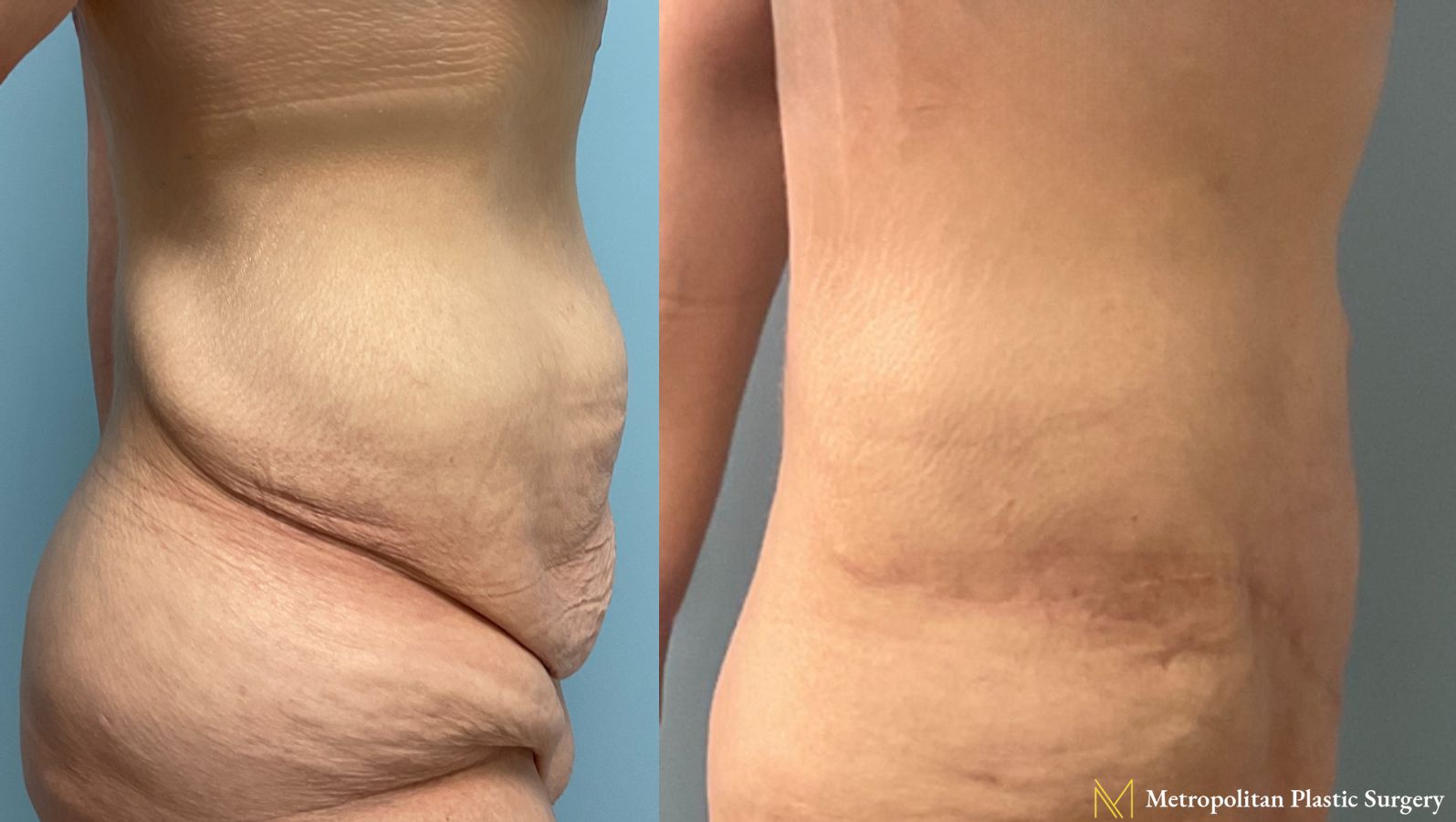 Tummy Tuck performed by Dr. Julia Spears at Metropolitan Plastic Surgery - Angle 3