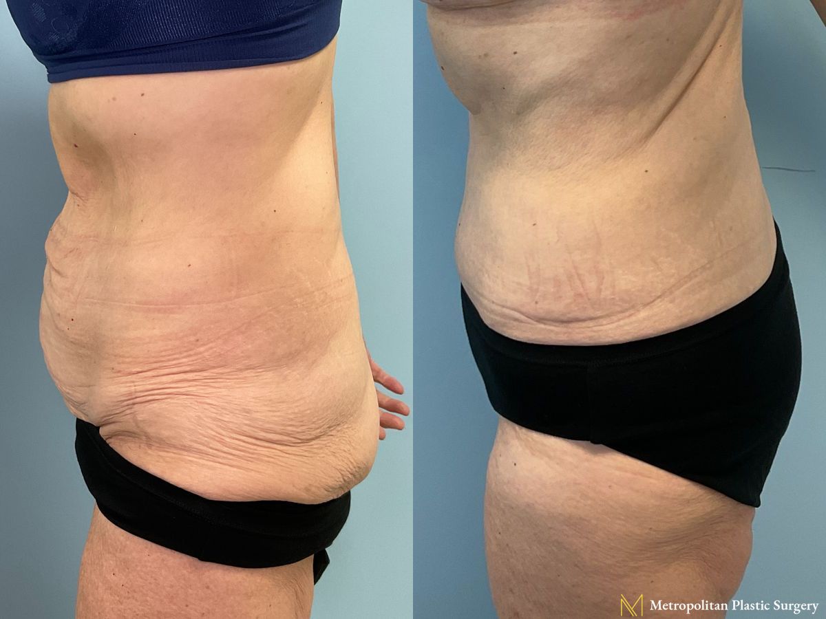 Vertical Tummy Tuck performed by Dr. Julia Spears at Metropolitan Plastic Surgery