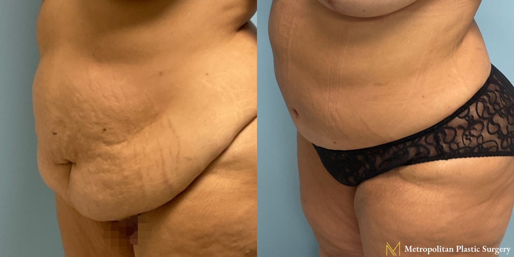Before and after Tummy Tuck case 8052 - Angle 4