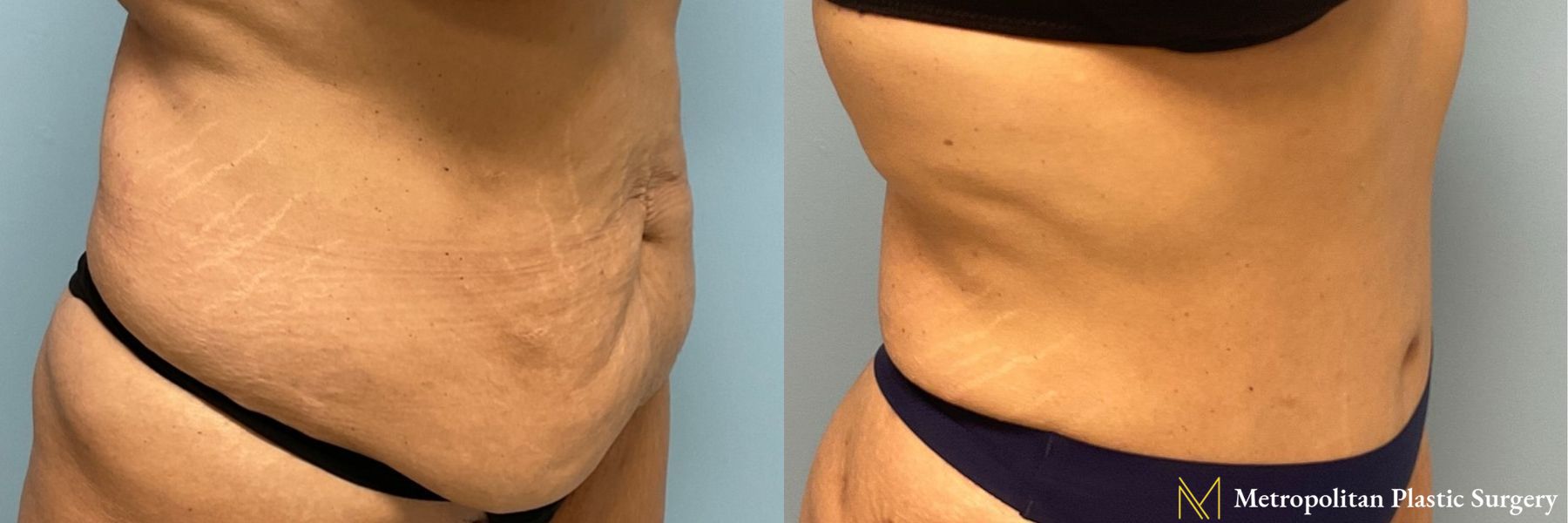 Before & after abdominoplasty photos for abdominoplasty - Angle 3