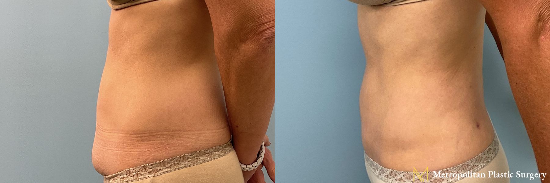 Before and after Tummy Tuck case 23849 - Angle 3