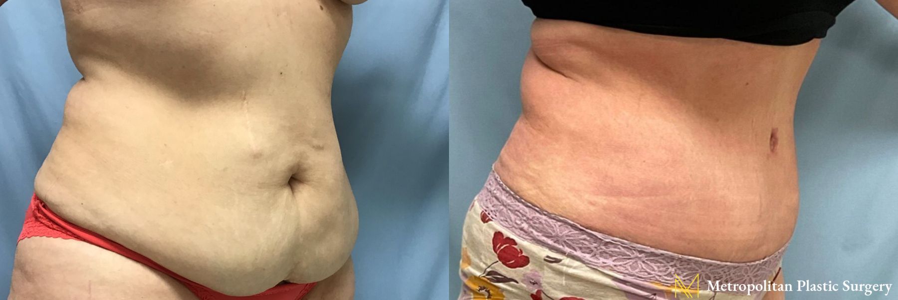 Before and after Liposuction case 21657 - Angle 3