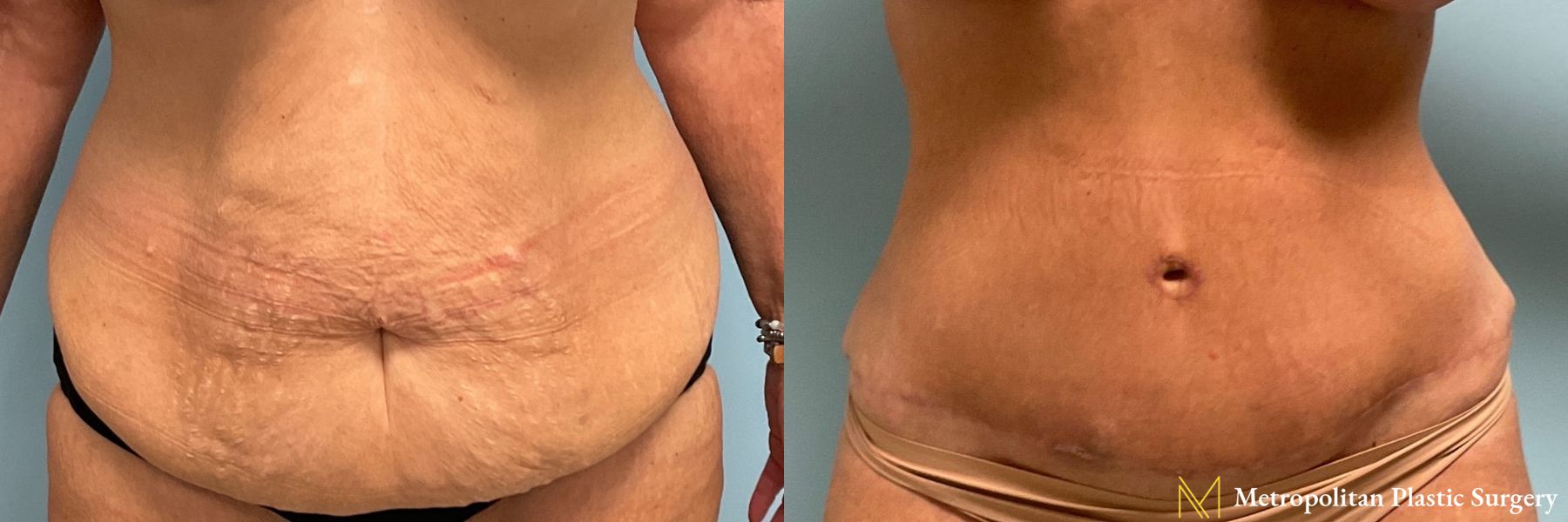 Before & after abdominoplasty photos for abdominoplasty