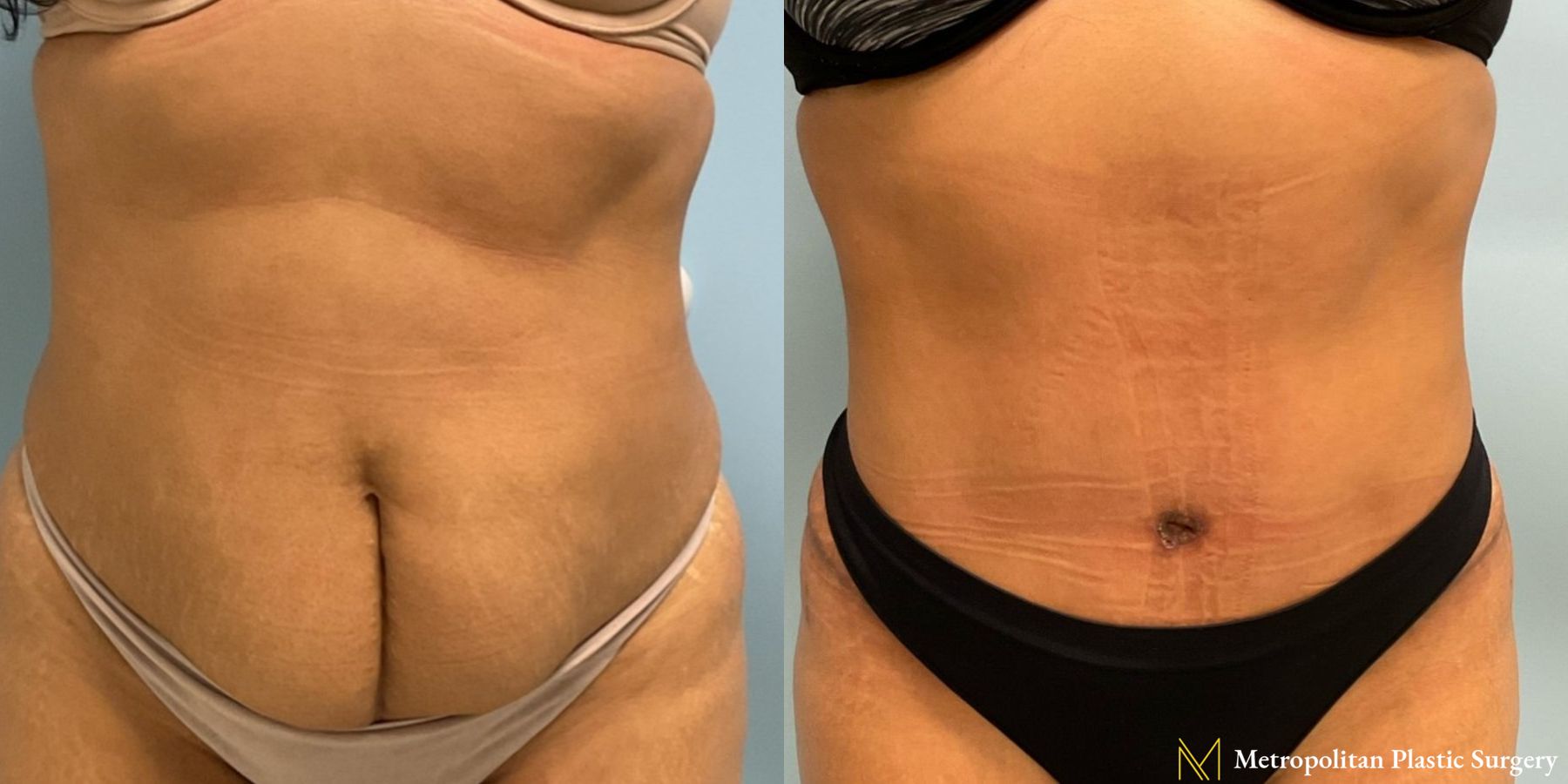 Before & after abdominoplasty photos for abdominoplasty