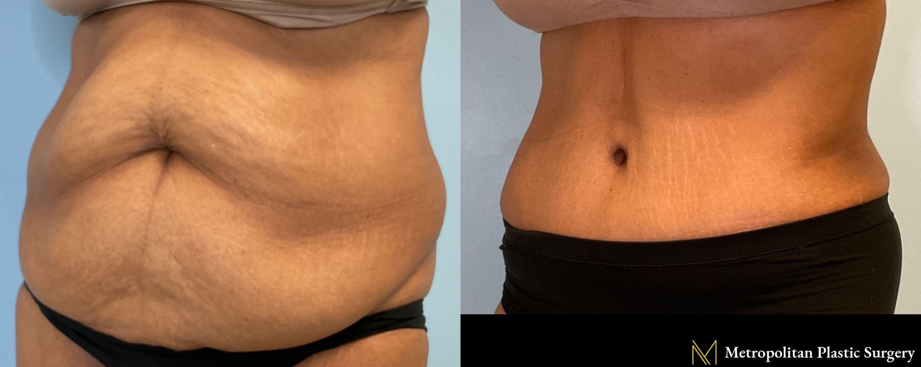 Tummy Tuck performed by Dr. Julia Spears