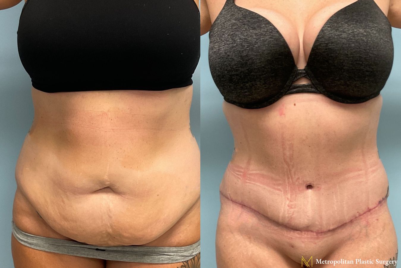 Before and after Tummy Tuck case 8006