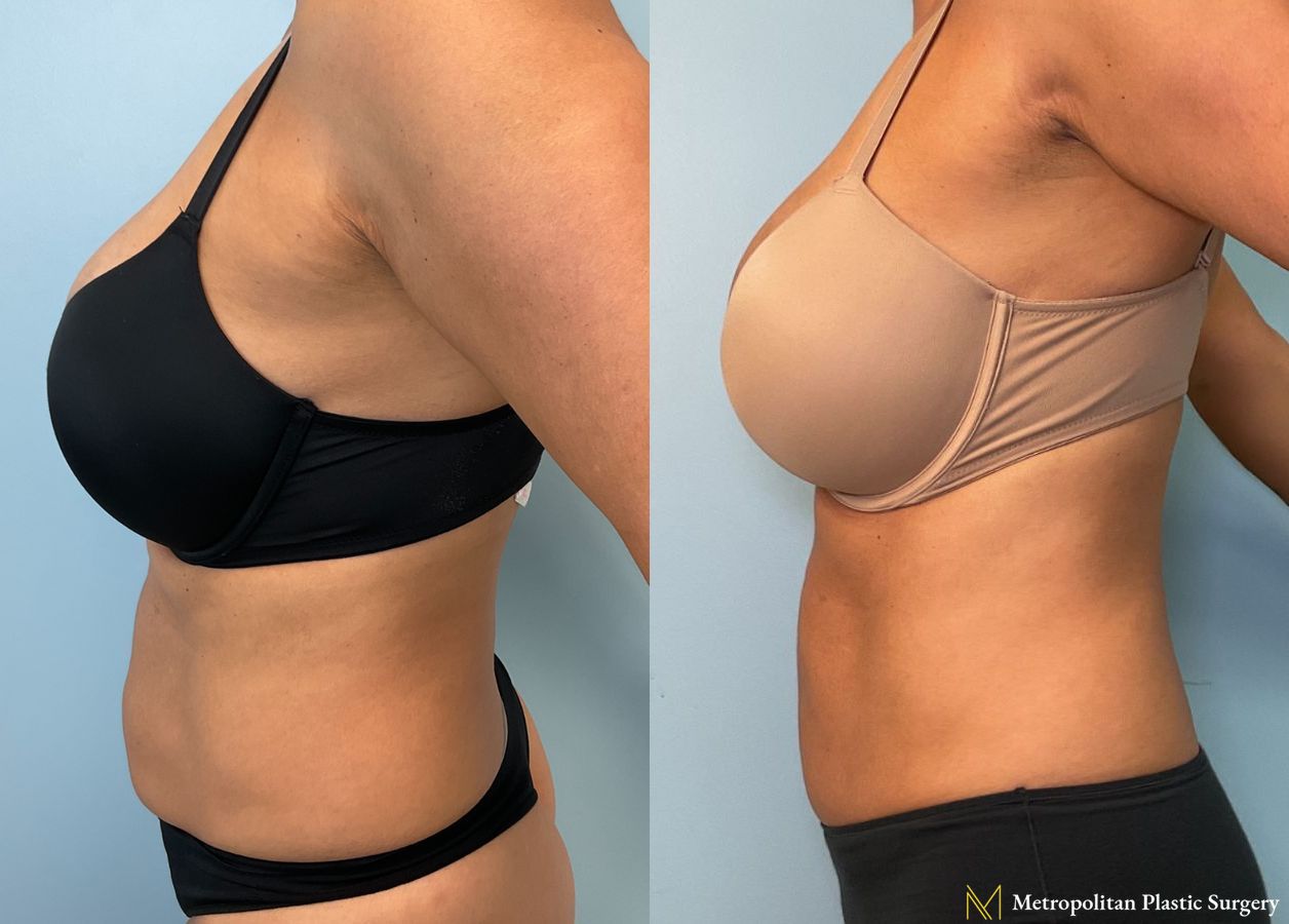 Mini Tummy Tuck performed by Dr. Julia Spears - Angle 2