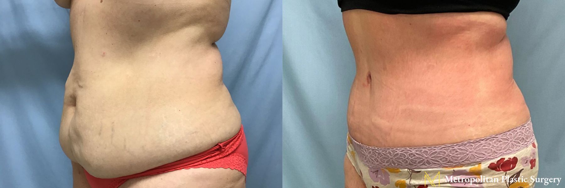 Before and after Liposuction case 21657 - Angle 2
