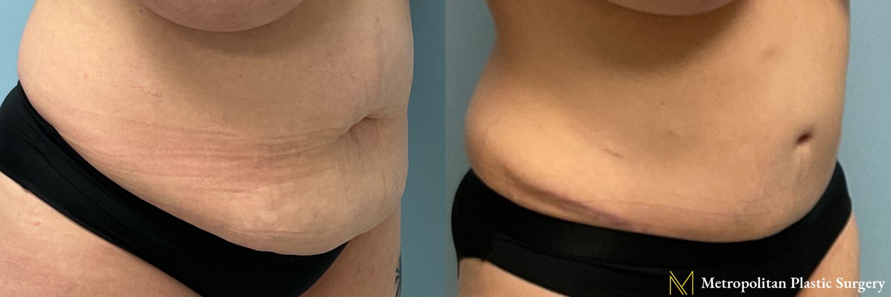 Before and after Tummy Tuck case 19254 - Angle 2