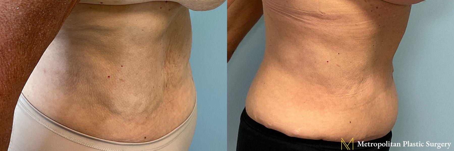 Before and after Tummy Tuck case 41756 - Angle 3