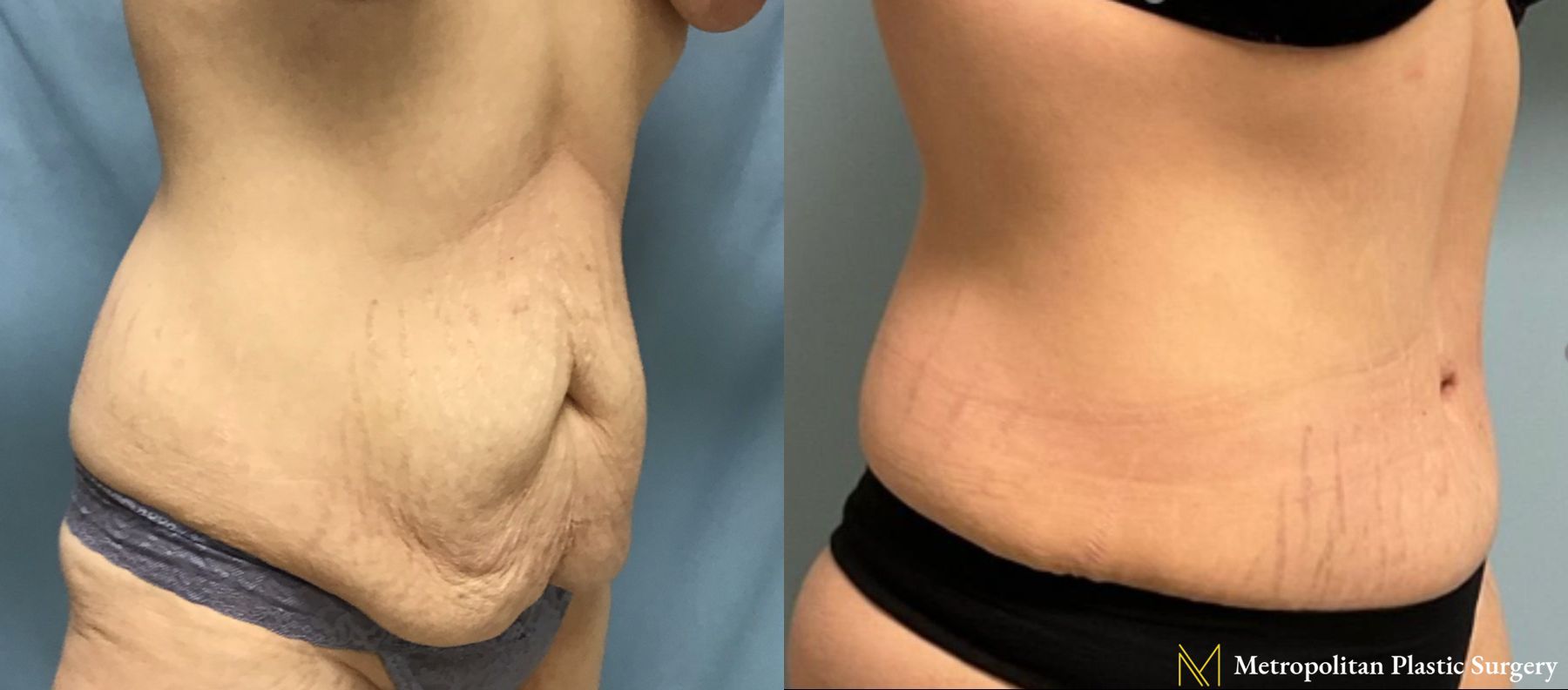 Before and after Brazilian Butt Lift case 21779 - Angle 4