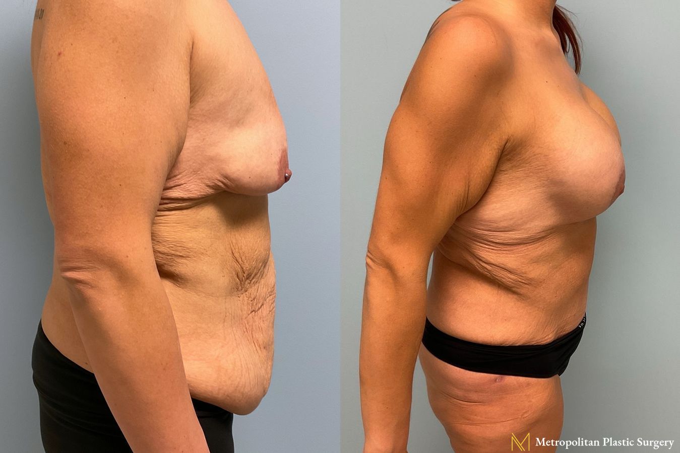 Before and after Tummy Tuck case 8044 - Angle 2