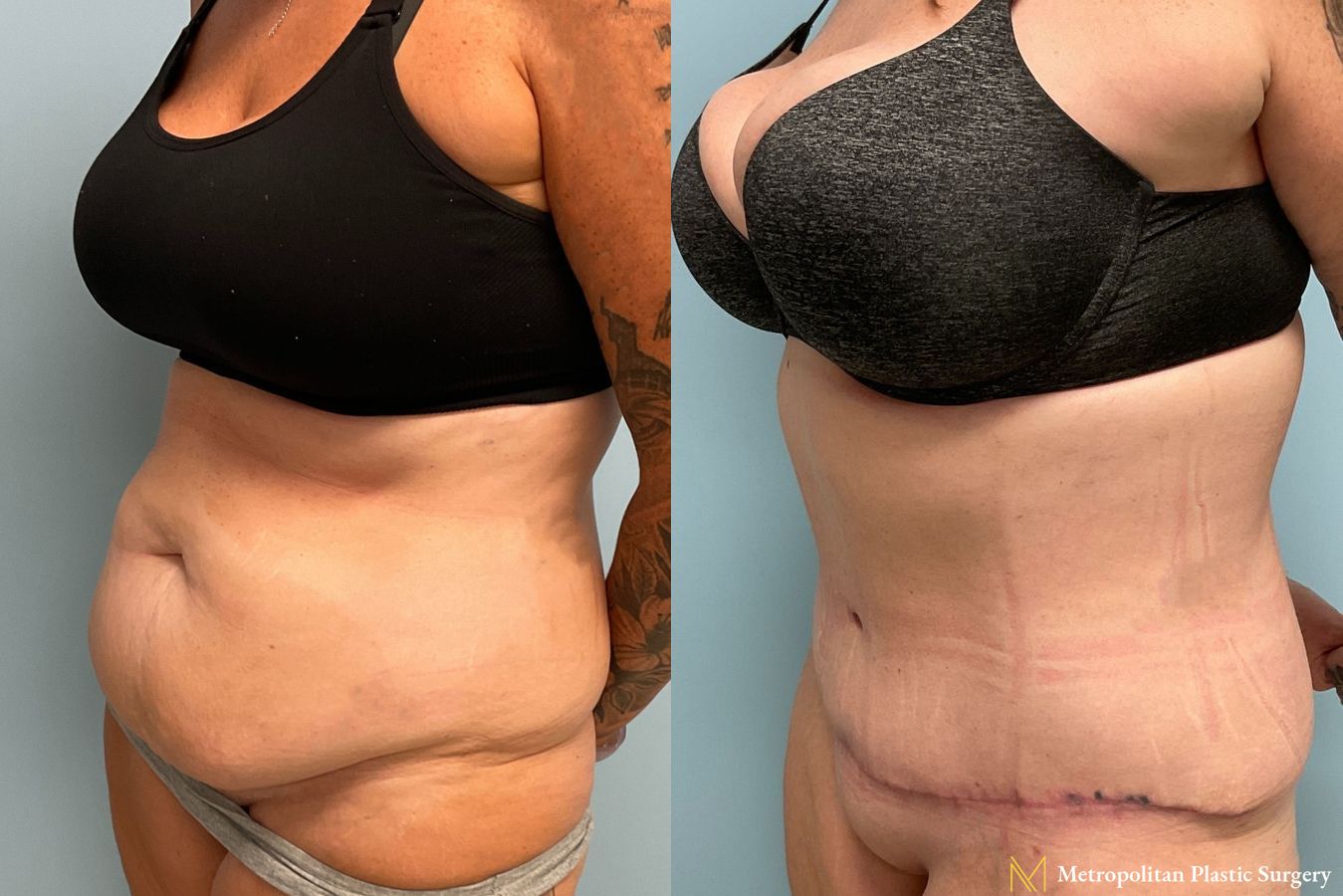 Before and after Tummy Tuck case 8006 - Angle 3