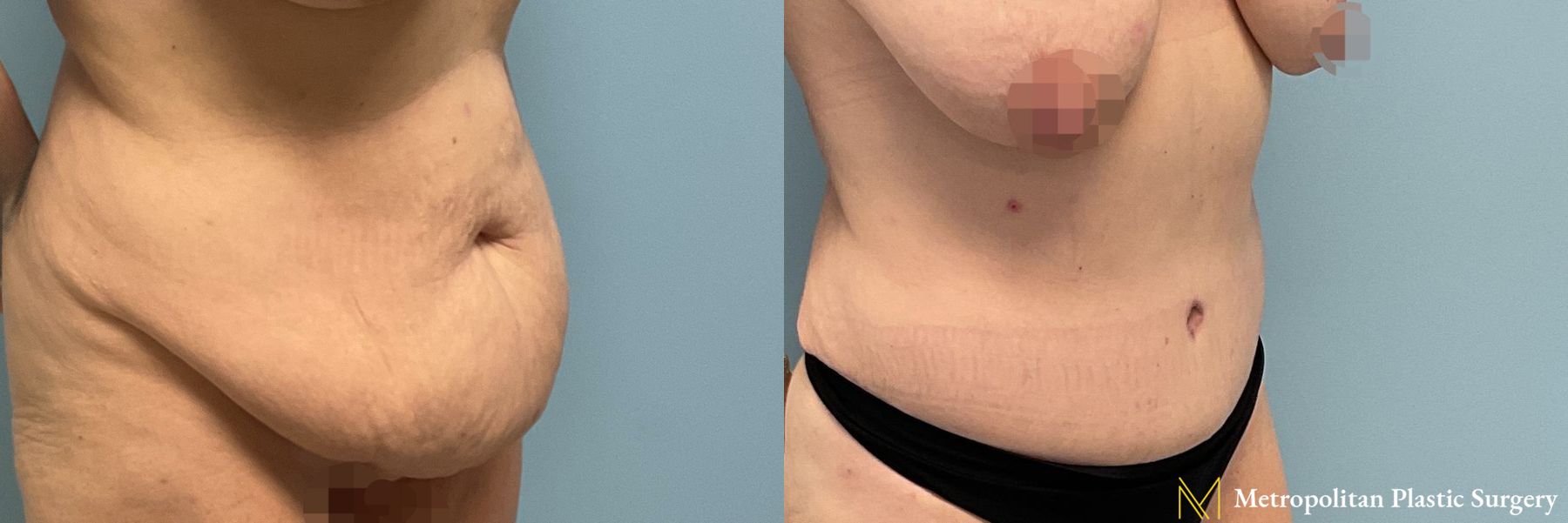 Tummy Tuck performed by Dr. Julia Spears - Angle 2