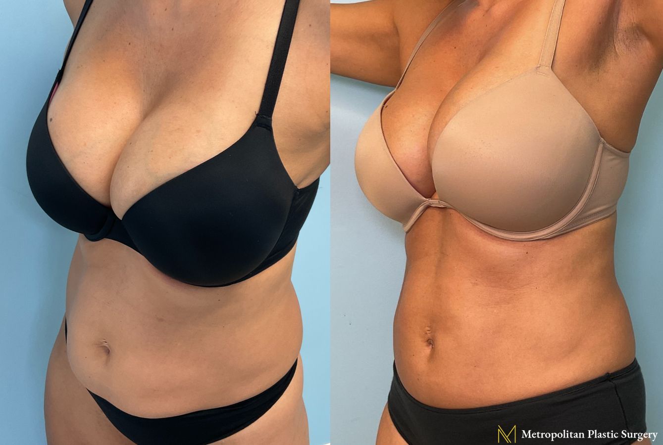 Mini Tummy Tuck performed by Dr. Julia Spears - Angle 3