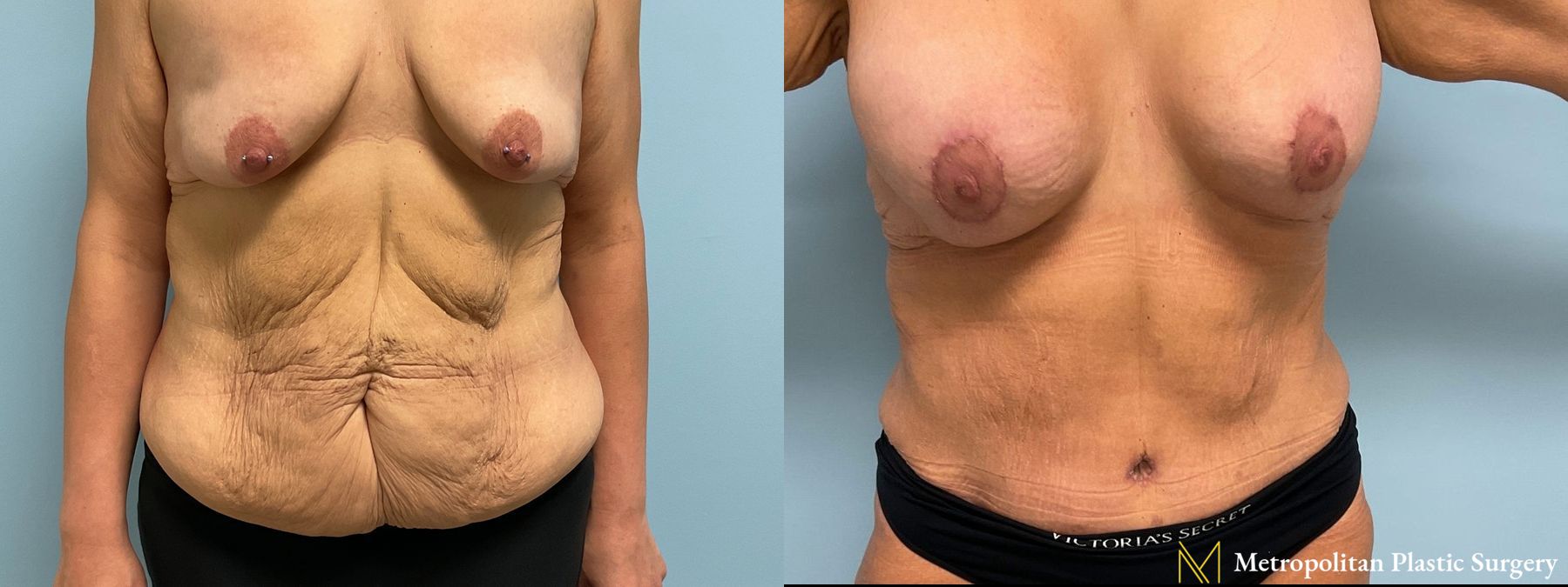 Before and after Tummy Tuck case 8044