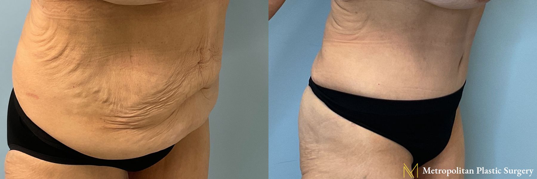 Before and after Tummy Tuck case 41784 - Angle 3