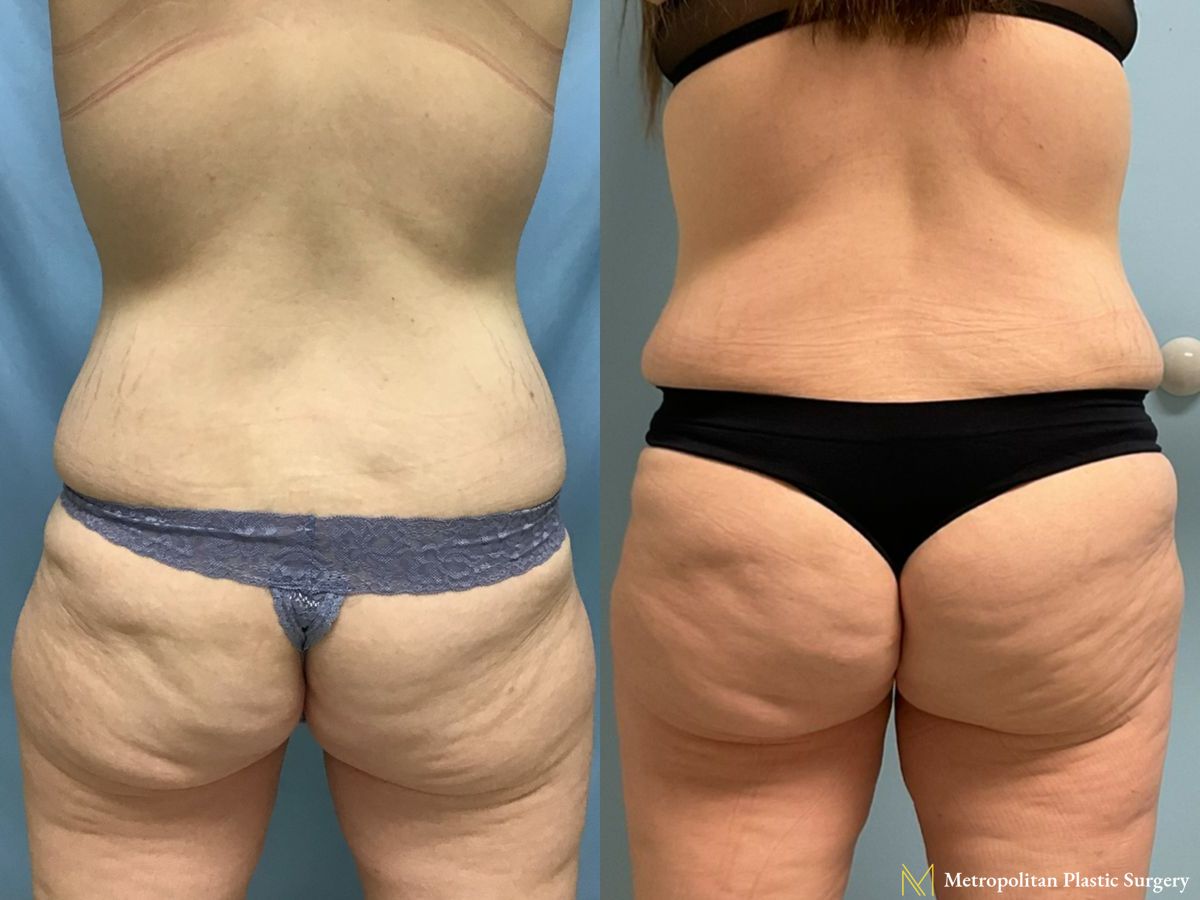 Before and after Brazilian Butt Lift case 21779 - Angle 2