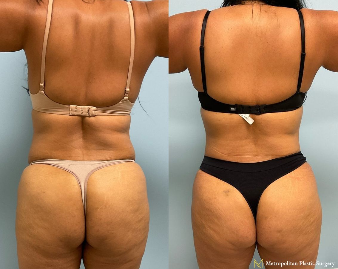Before and after Tummy Tuck case 8013 - Angle 3