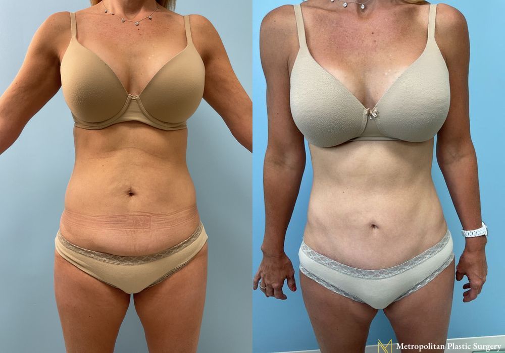 Liposuction - Case 199