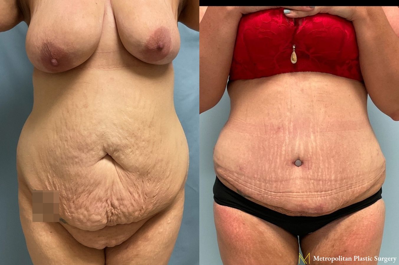 Before and after Tummy Tuck case 8051