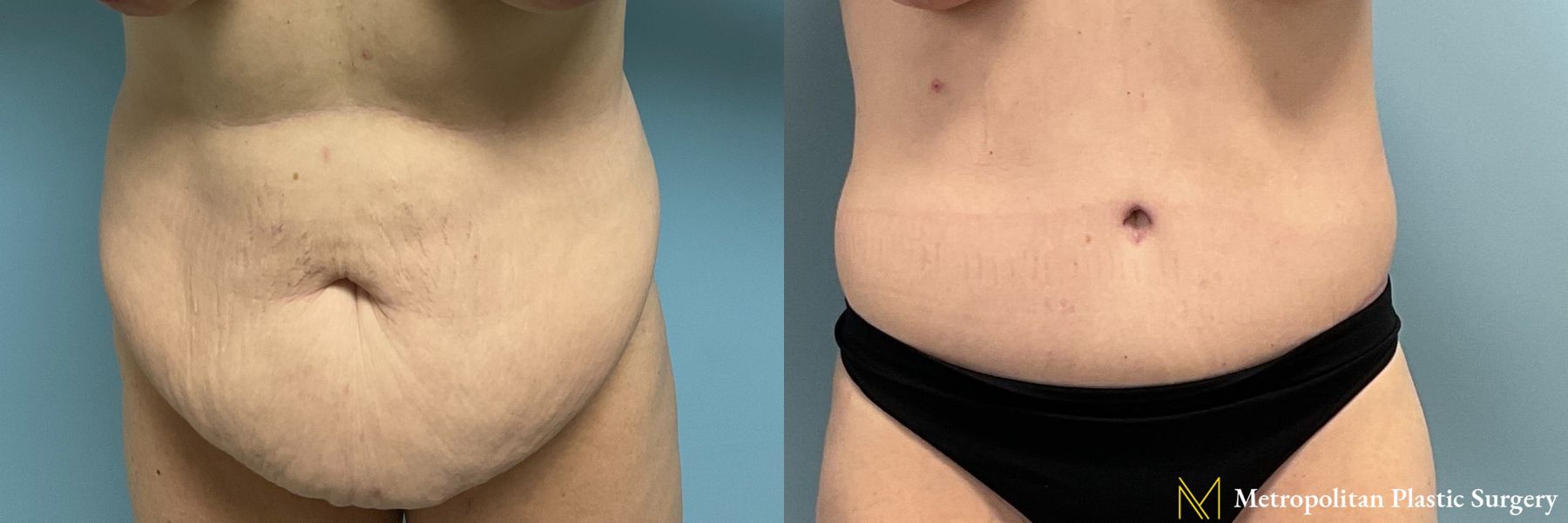 Tummy Tuck performed by Dr. Julia Spears