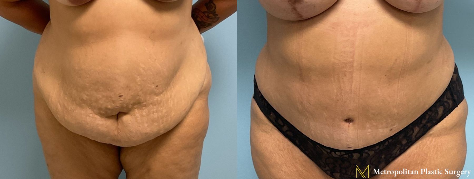 Before and after Tummy Tuck case 8052