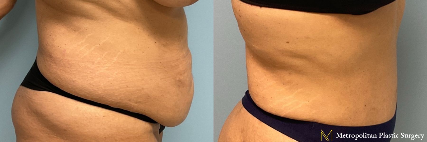 Before & after abdominoplasty photos for abdominoplasty - Angle 2