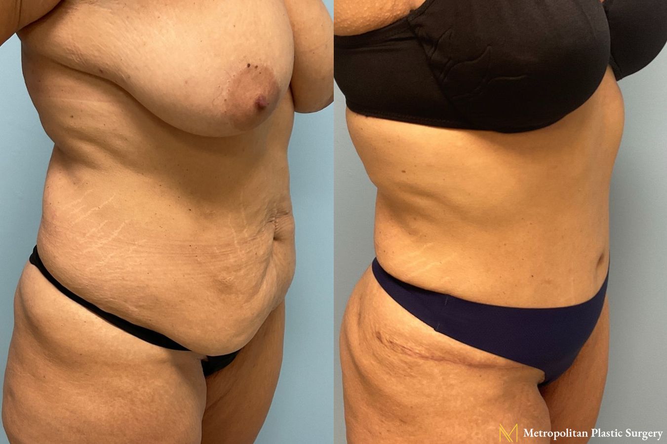 Before and after Tummy Tuck case 8020 - Angle 3