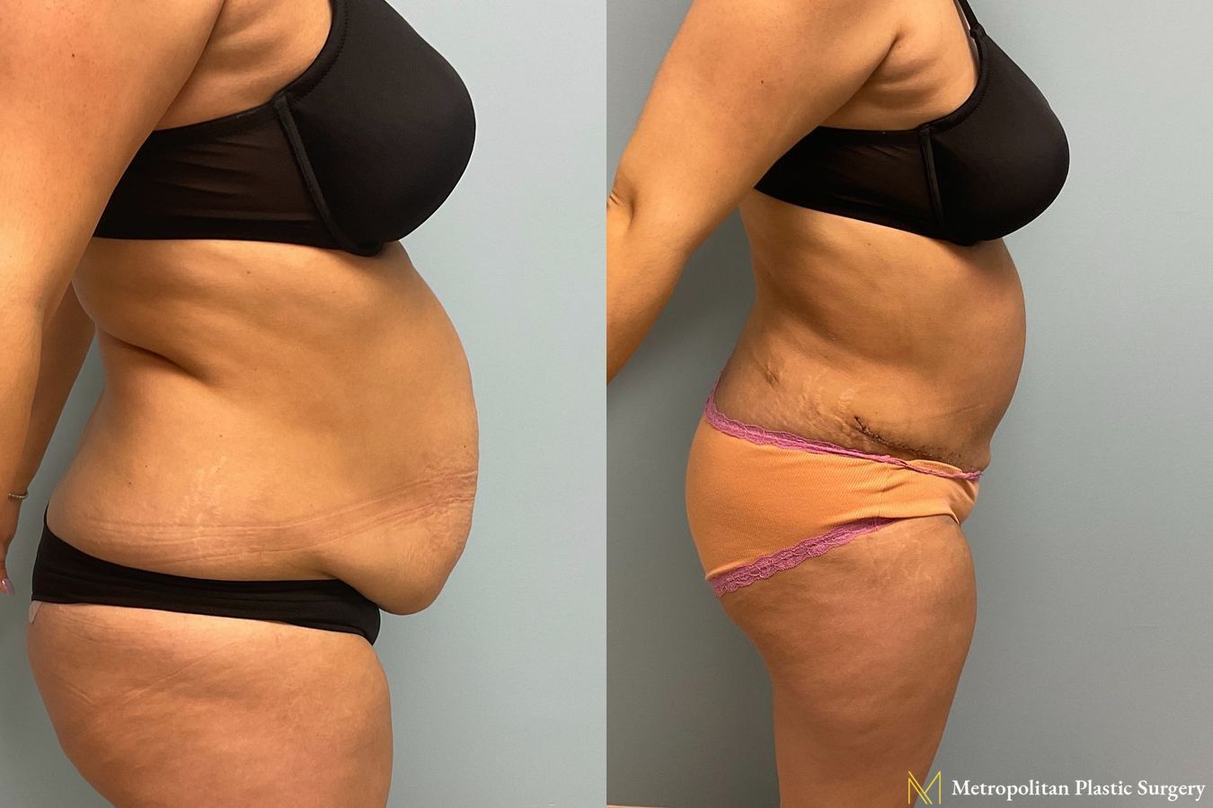 Before and after Tummy Tuck case 8041 - Angle 2
