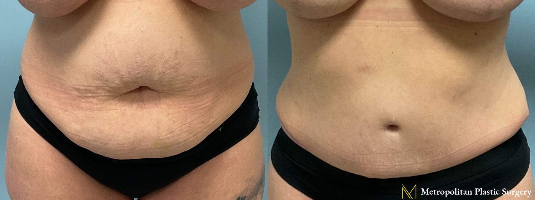 Before and after Tummy Tuck case 19254