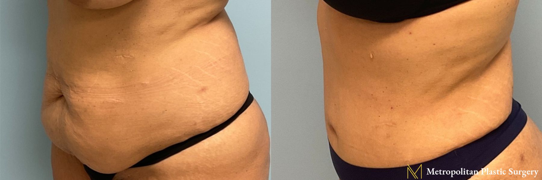 Before & after abdominoplasty photos for abdominoplasty - Angle 5