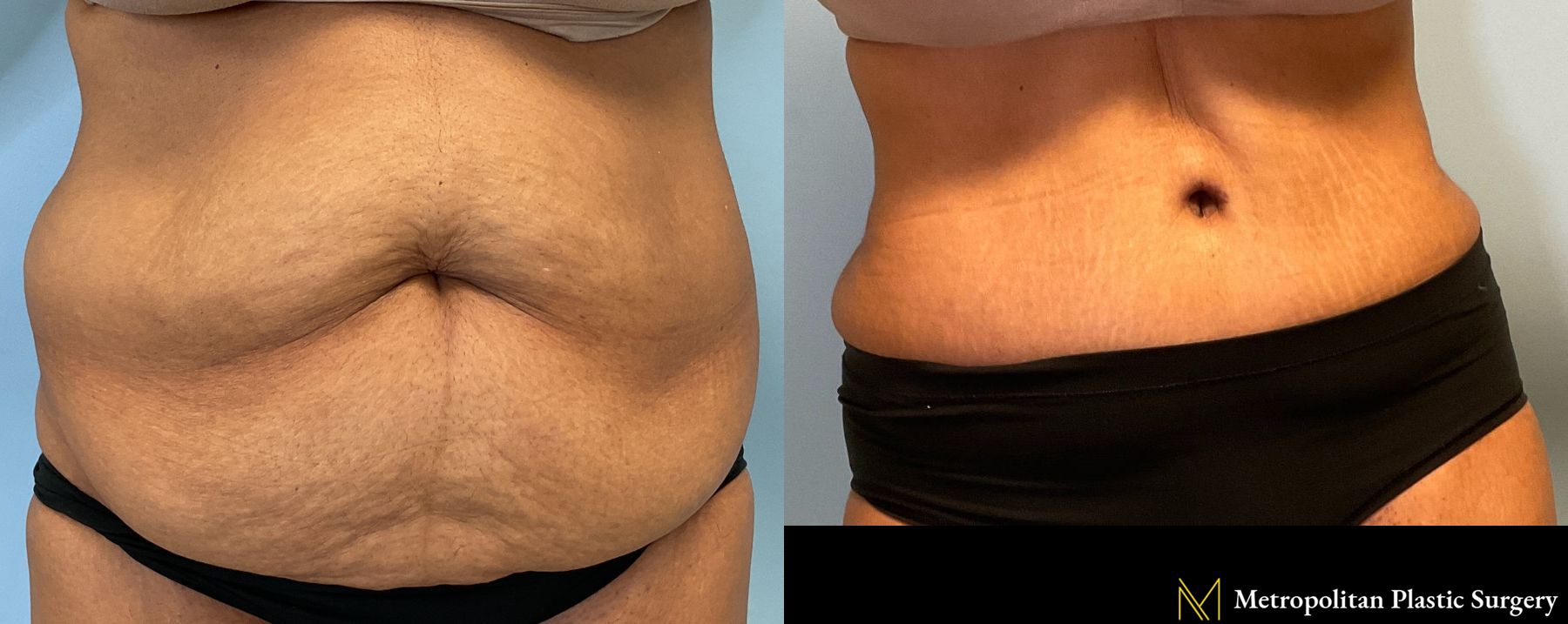 Tummy Tuck performed by Dr. Julia Spears - Angle 3