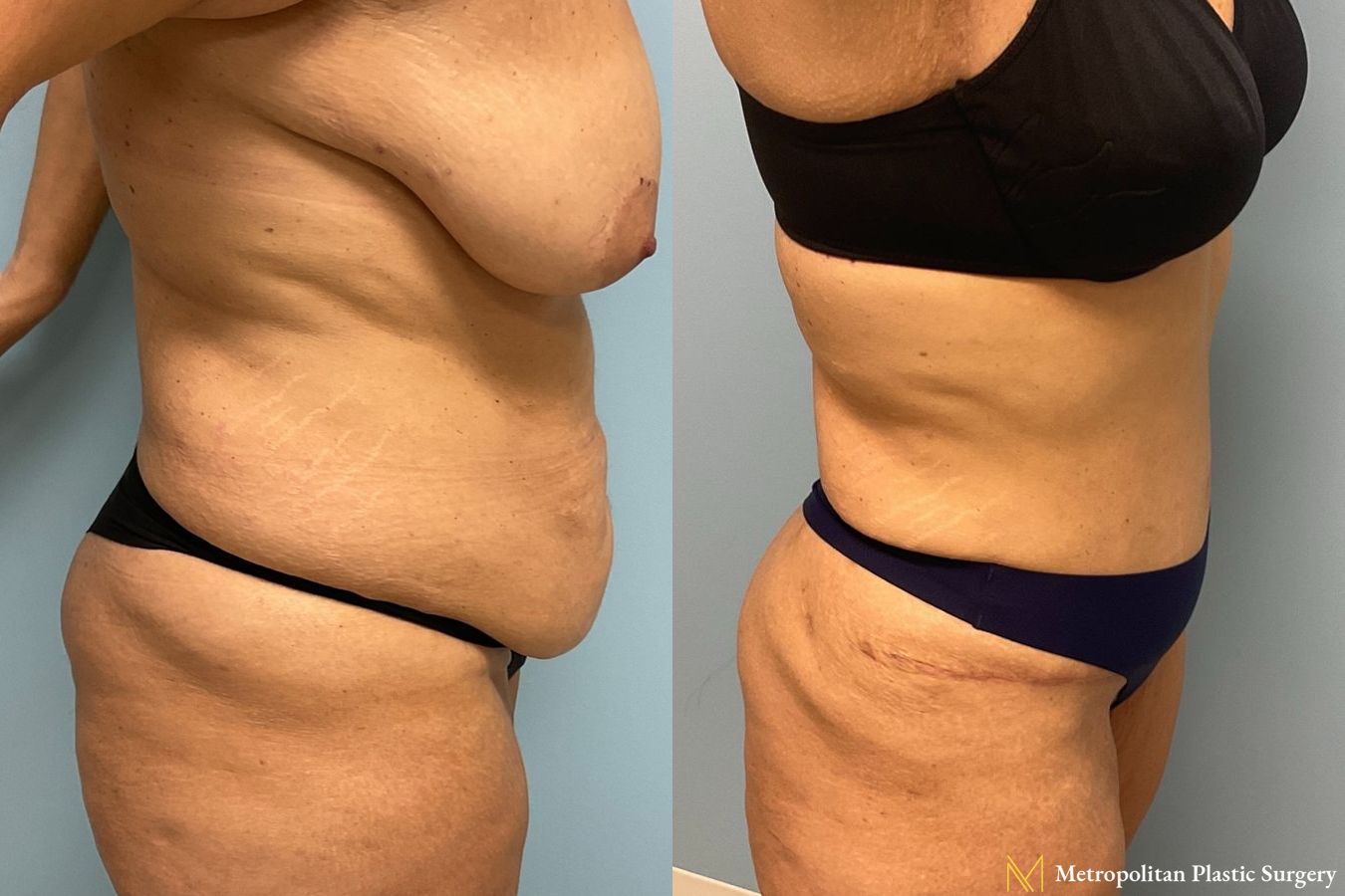 Before and after Tummy Tuck case 8020 - Angle 2