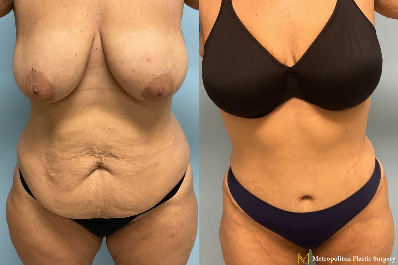 Before and after Tummy Tuck case 8020
