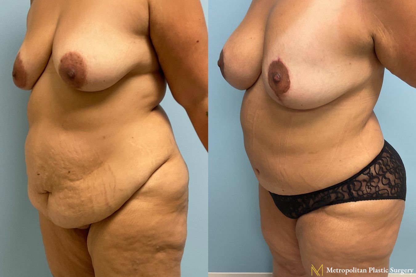 Before and after Tummy Tuck case 8052 - Angle 4