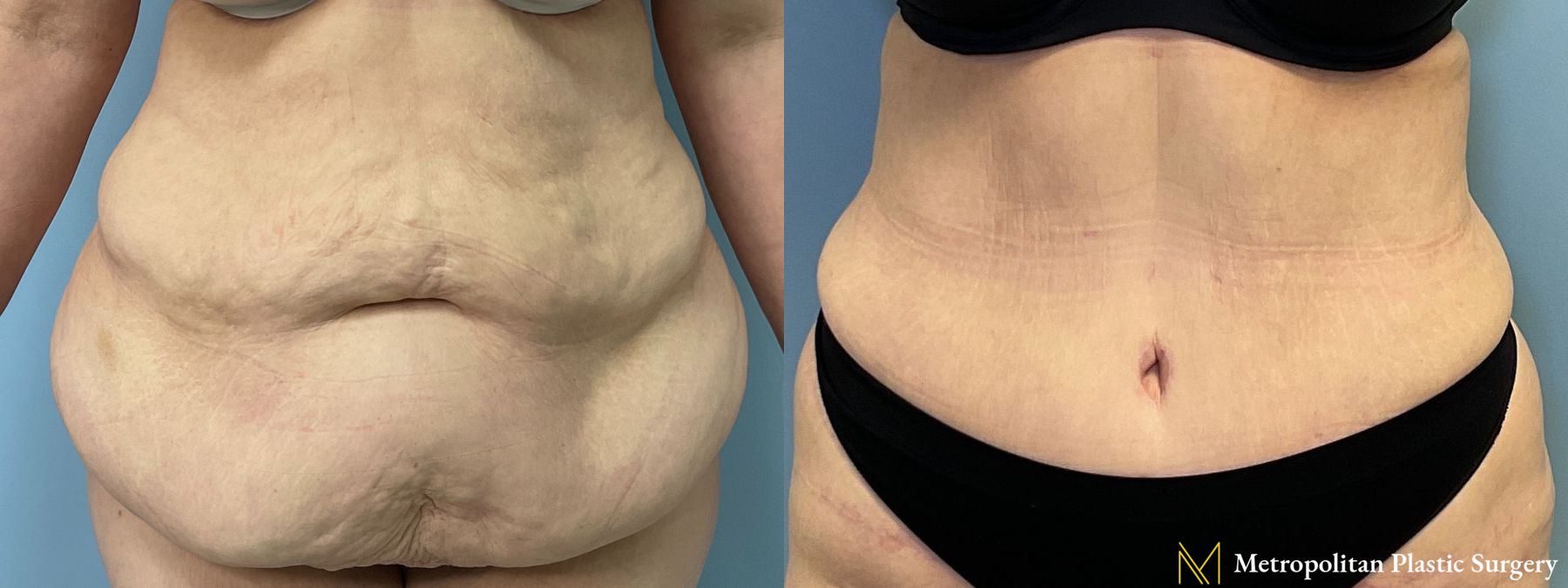 Tummy Tuck performed by Dr. Julia Spears