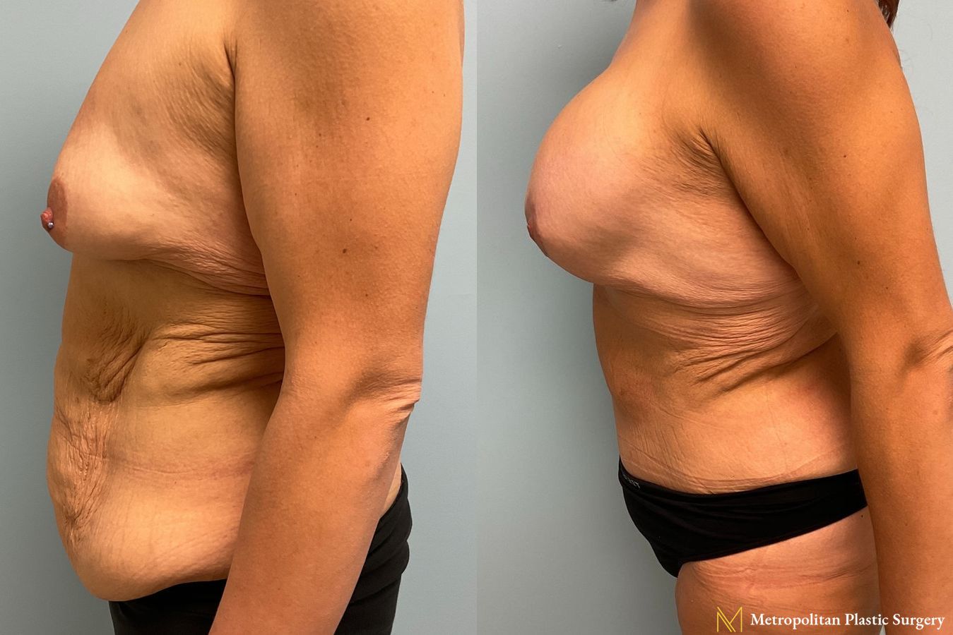 Before and after Tummy Tuck case 8044 - Angle 4