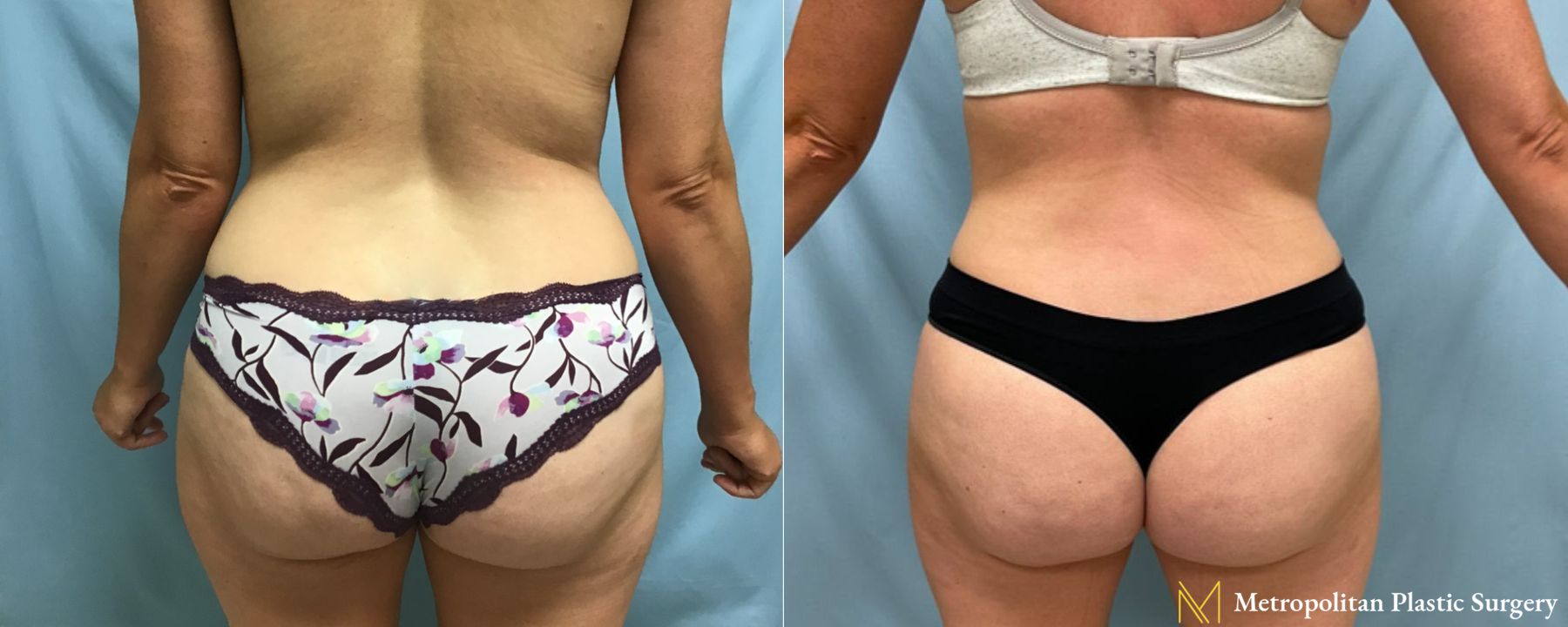 Before and after Tummy Tuck case 41785 - Angle 3