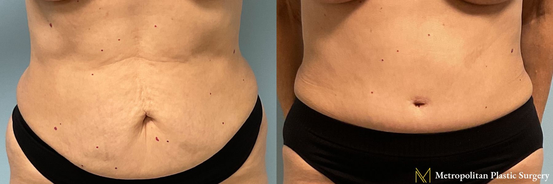 Tummy Tuck performed by Dr. Julia Spears