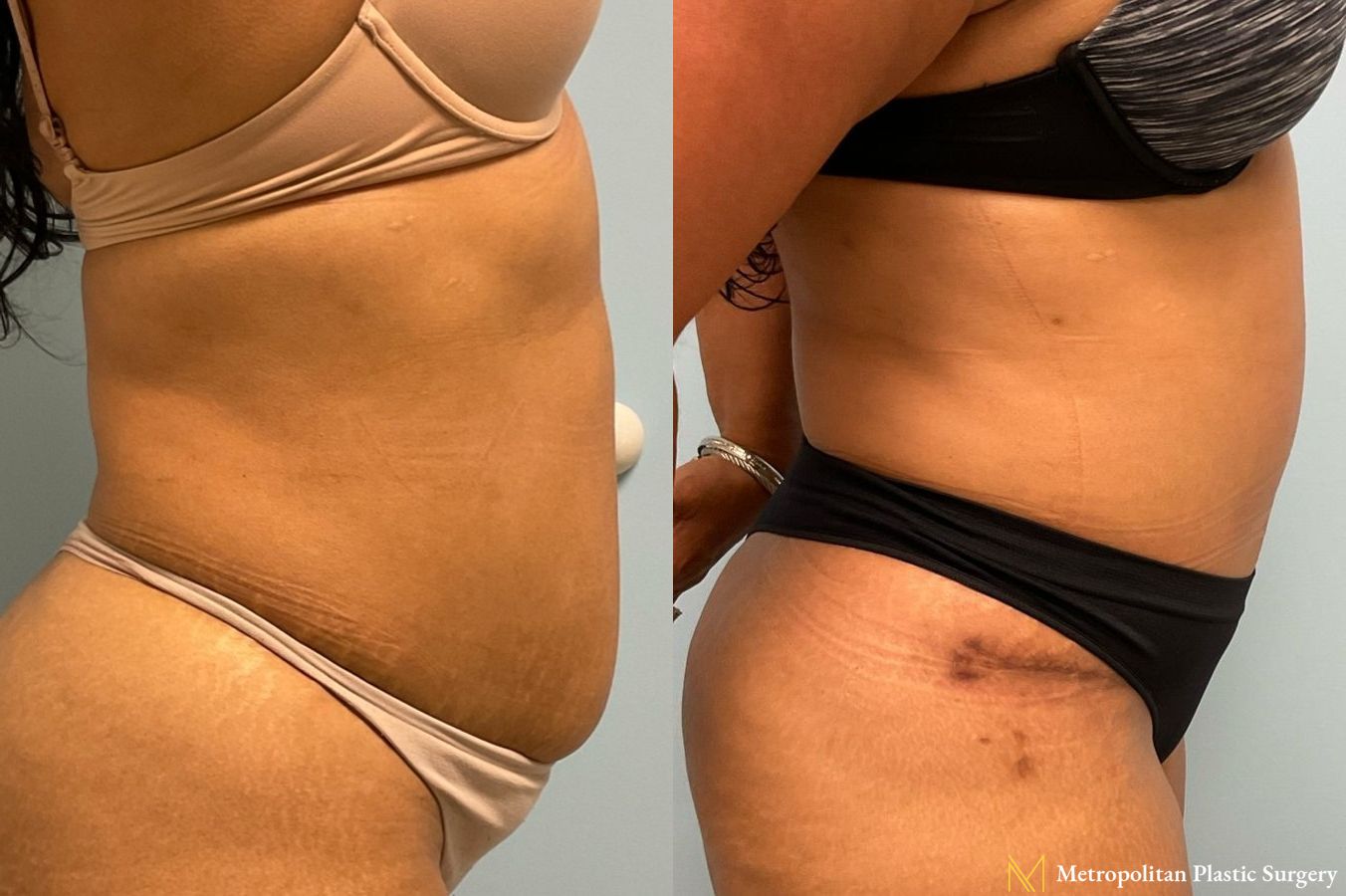 Before and after Tummy Tuck case 8013 - Angle 2