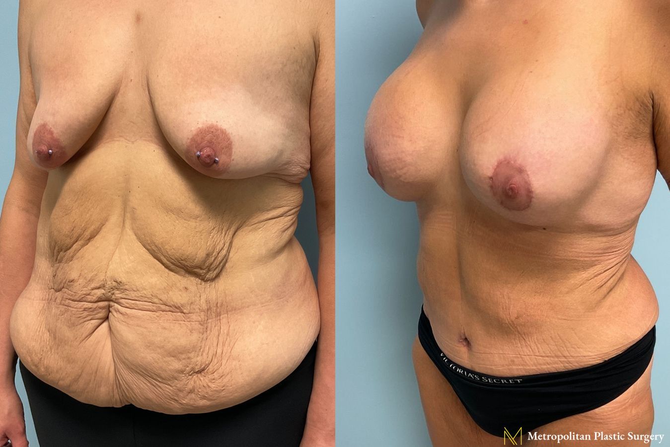 Before and after Tummy Tuck case 8044 - Angle 3