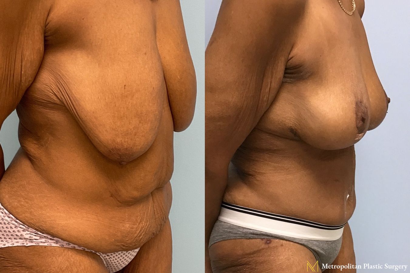 Before and after Tummy Tuck case 7999 - Angle 3