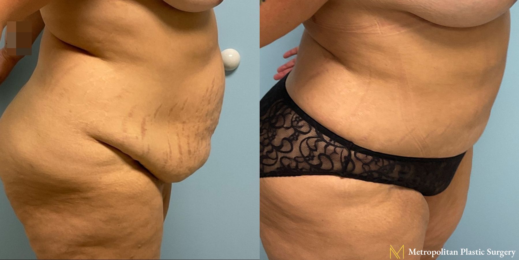 Before and after Tummy Tuck case 8052 - Angle 2